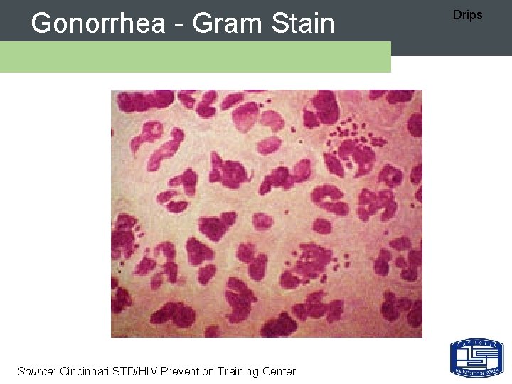 Gonorrhea - Gram Stain Source: Cincinnati STD/HIV Prevention Training Center Drips 