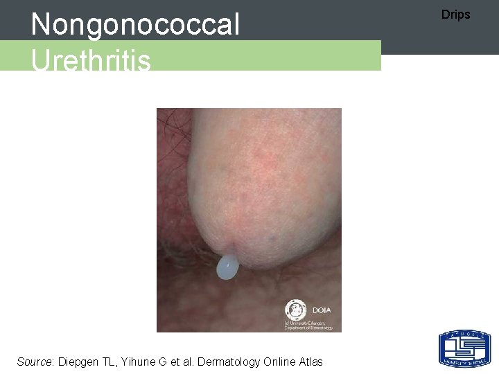 Nongonococcal Urethritis Source: Diepgen TL, Yihune G et al. Dermatology Online Atlas Drips 