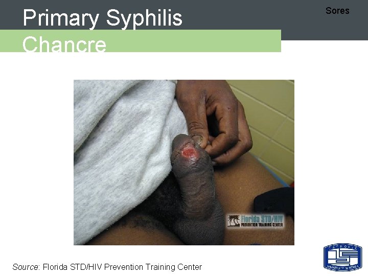 Primary Syphilis Chancre Source: Florida STD/HIV Prevention Training Center Sores 