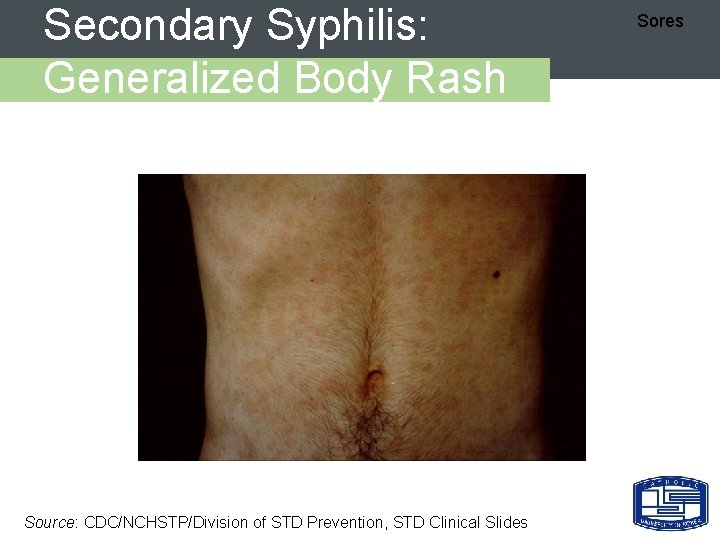 Secondary Syphilis: Generalized Body Rash Source: CDC/NCHSTP/Division of STD Prevention, STD Clinical Slides Sores