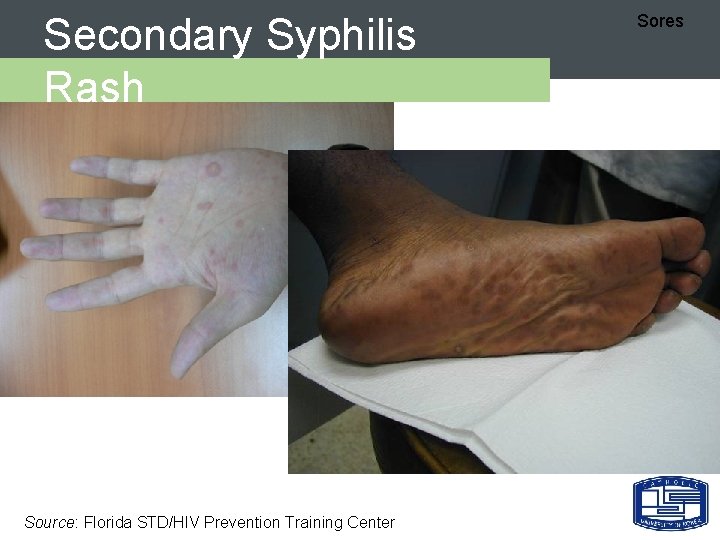 Secondary Syphilis Rash Source: Florida STD/HIV Prevention Training Center Sores 