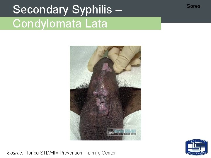 Secondary Syphilis – Condylomata Lata Source: Florida STD/HIV Prevention Training Center Sores 