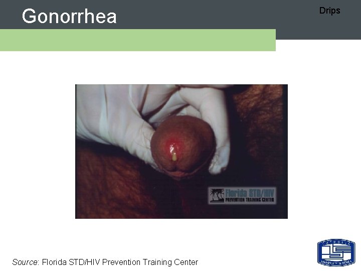 Gonorrhea Source: Florida STD/HIV Prevention Training Center Drips 
