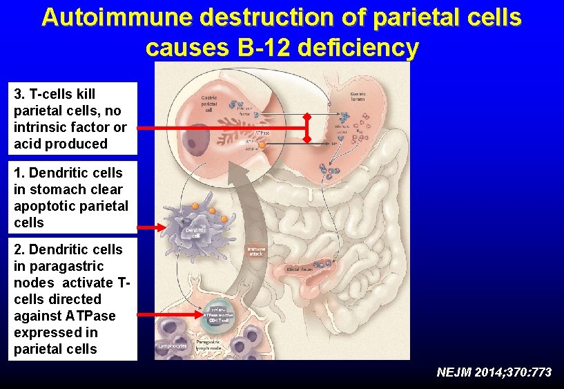Autoimmune destruction of parietal cells causes B-12 deficiency 3. T-cells kill parietal cells, no