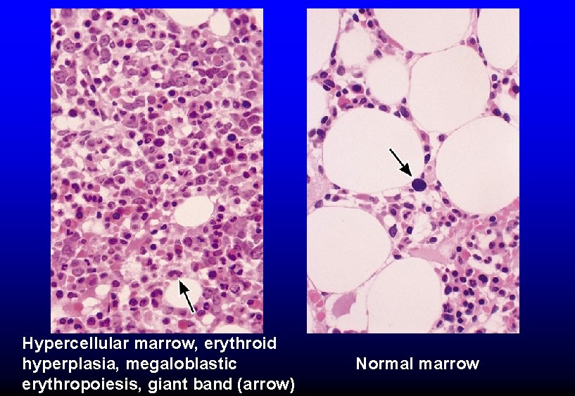 Hypercellular marrow, erythroid hyperplasia, megaloblastic erythropoiesis, giant band (arrow) Normal marrow 
