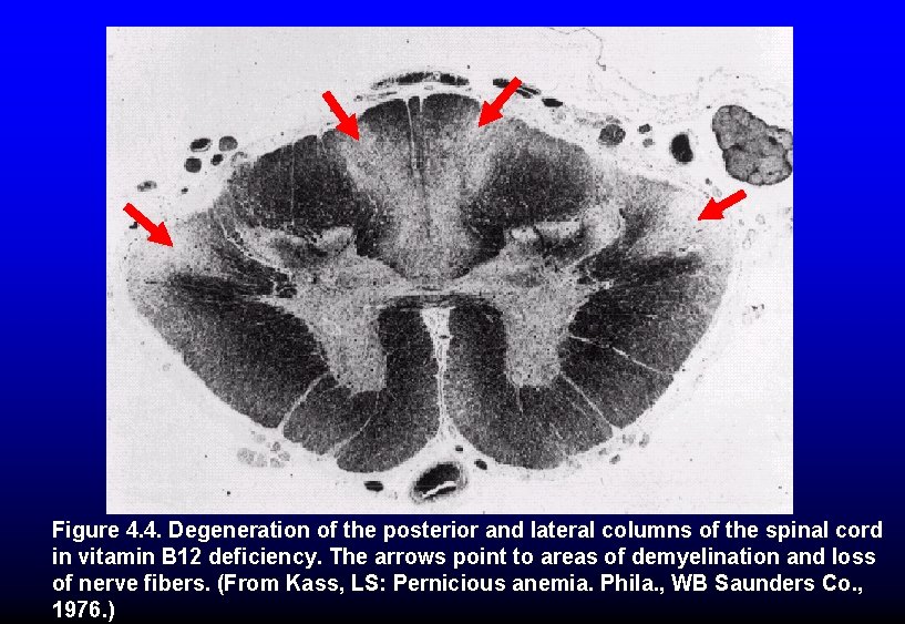 Figure 4. 4. Degeneration of the posterior and lateral columns of the spinal cord
