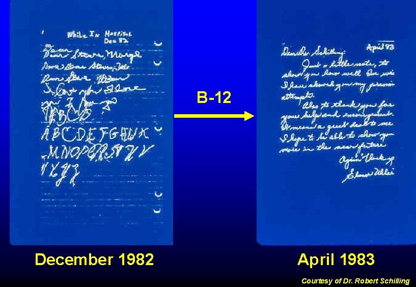 B-12 December 1982 April 1983 Courtesy of Dr. Robert Schilling 