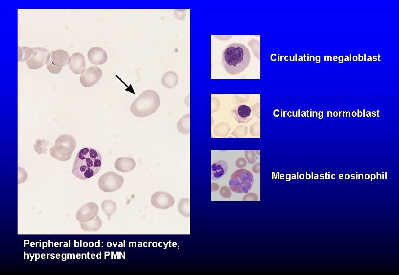 Circulating megaloblast Circulating normoblast Megaloblastic eosinophil Peripheral blood: oval macrocyte, hypersegmented PMN 