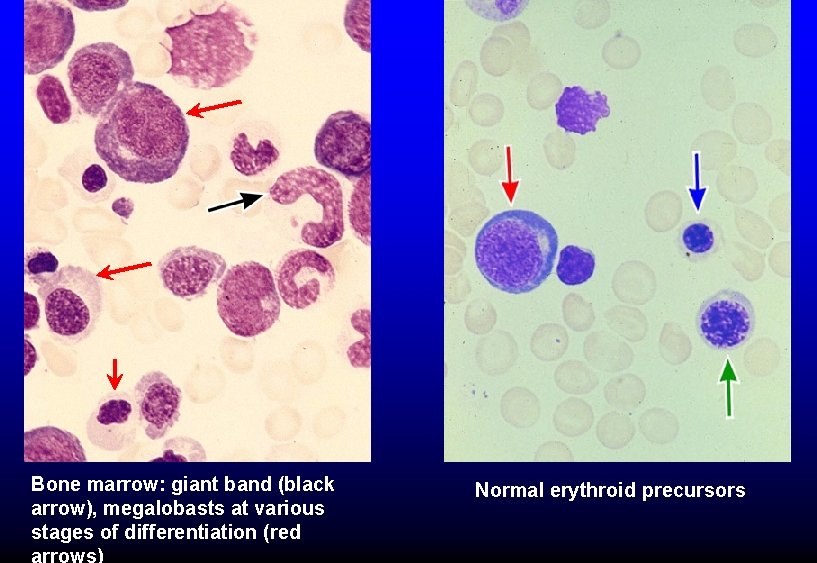 Bone marrow: giant band (black arrow), megalobasts at various stages of differentiation (red Normal