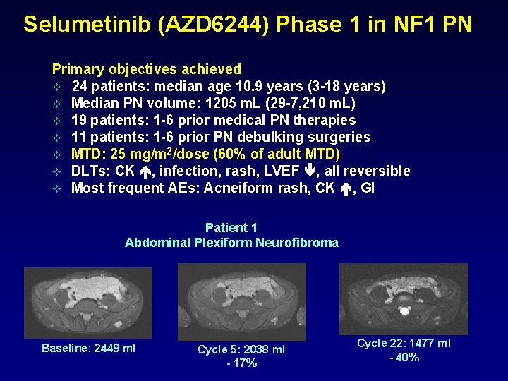 Selumetinib (AZD 6244) Phase 1 in NF 1 PN Primary objectives achieved v 24
