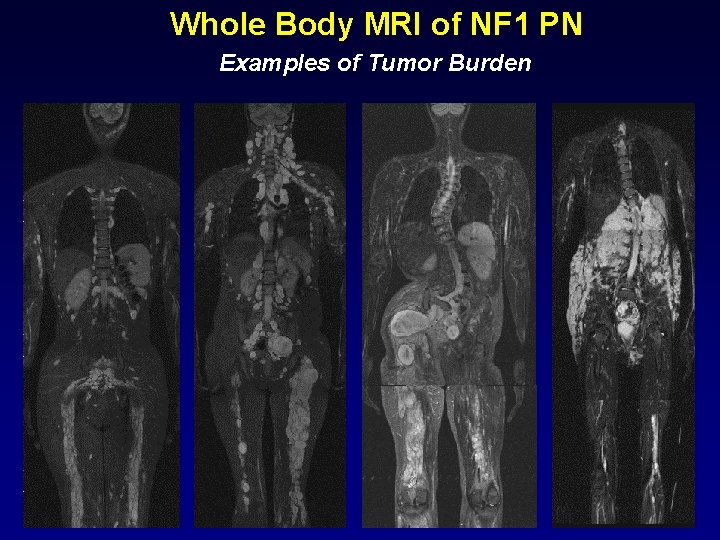 Whole Body MRI of NF 1 PN Examples of Tumor Burden 