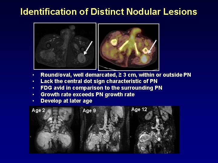 Identification of Distinct Nodular Lesions • • • Round/oval, well demarcated, ≥ 3 cm,