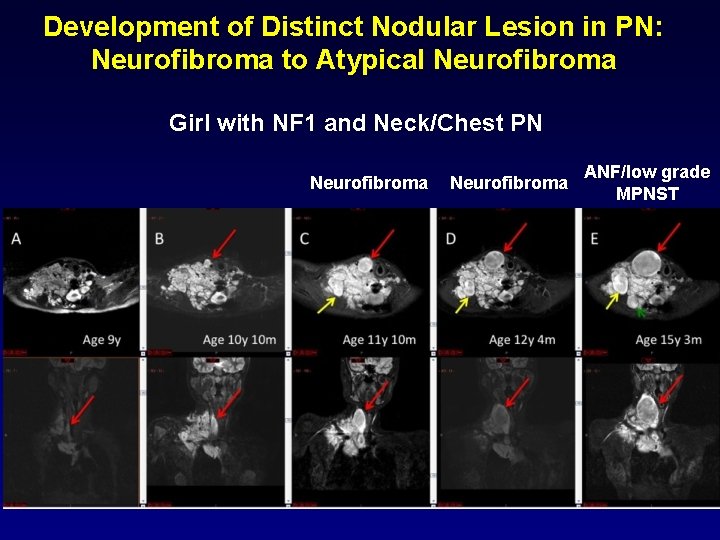 Development of Distinct Nodular Lesion in PN: Neurofibroma to Atypical Neurofibroma Girl with NF