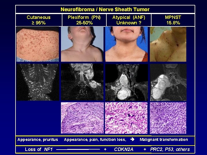 Neurofibroma / Nerve Sheath Tumor Cutaneous ≥ 95% Appearance, pruritus Loss of NF 1