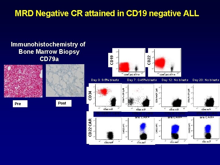 CD 19 Immunohistochemistry of Bone Marrow Biopsy CD 79 a Day 7: 0. 45%