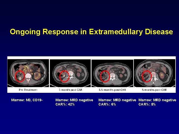 Ongoing Response in Extramedullary Disease Marrow: M 3, CD 19 - Marrow: MRD negative