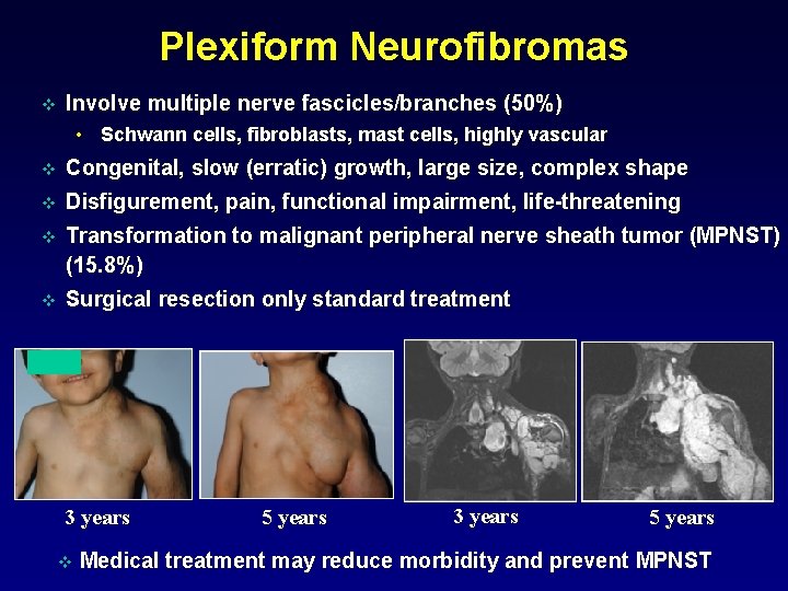 Plexiform Neurofibromas v Involve multiple nerve fascicles/branches (50%) • Schwann cells, fibroblasts, mast cells,