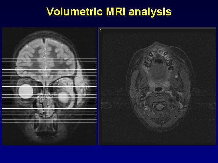 Volumetric MRI analysis 