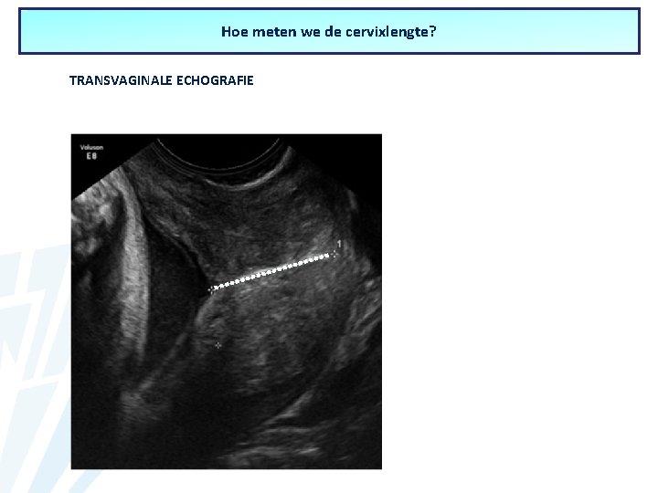 Hoe meten we de cervixlengte? TRANSVAGINALE ECHOGRAFIE 