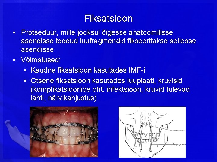 Fiksatsioon • Protseduur, mille jooksul õigesse anatoomilisse asendisse toodud luufragmendid fikseeritakse sellesse asendisse •