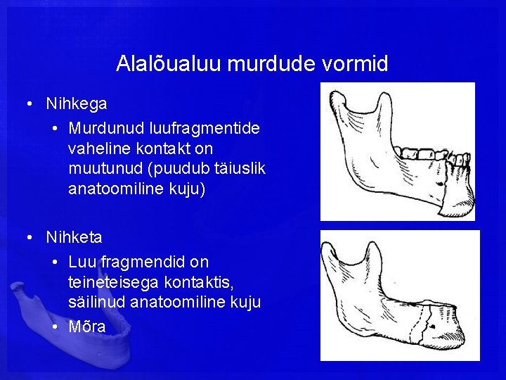 Alalõualuu murdude vormid • Nihkega • Murdunud luufragmentide vaheline kontakt on muutunud (puudub täiuslik