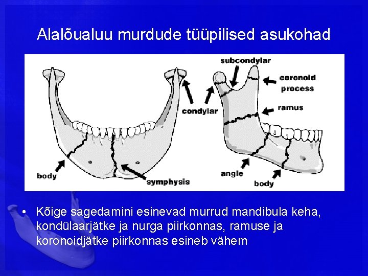 Alalõualuu murdude tüüpilised asukohad • Kõige sagedamini esinevad murrud mandibula keha, kondülaarjätke ja nurga