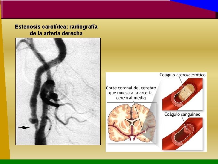 Estenosis carotídea; radiografía de la arteria derecha 