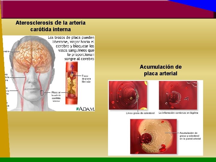 Aterosclerosis de la arteria carótida interna Acumulación de placa arterial 