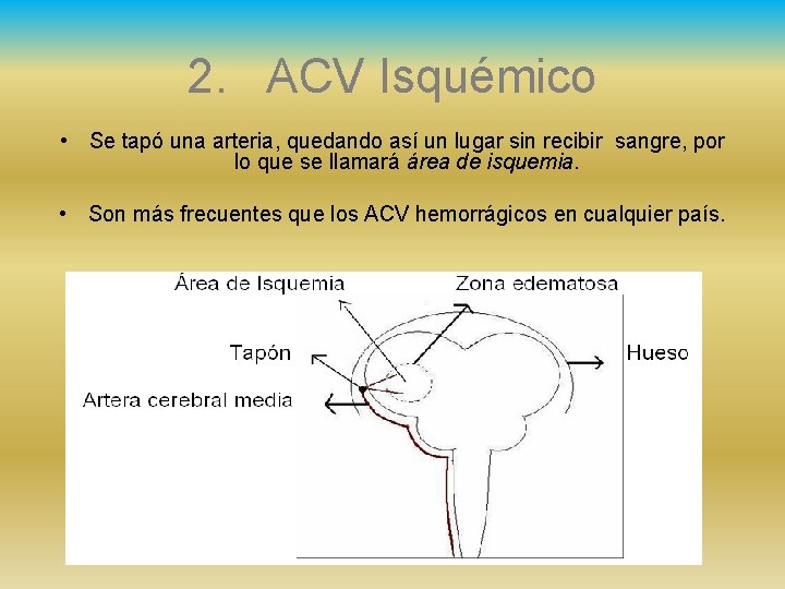 2. ACV Isquémico • Se tapó una arteria, quedando así un lugar sin recibir