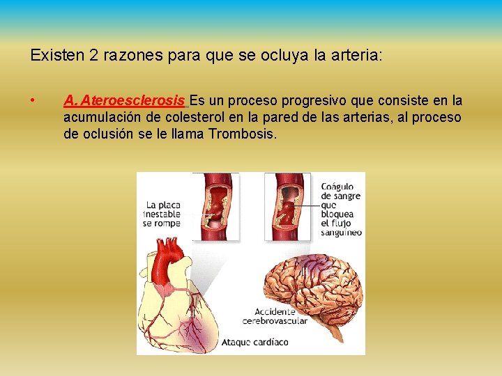 Existen 2 razones para que se ocluya la arteria: • A. Ateroesclerosis Es un