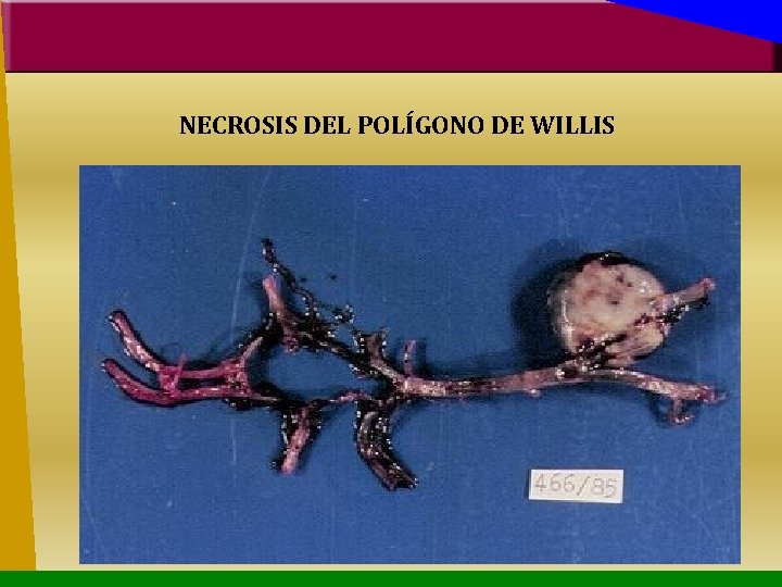 NECROSIS DEL POLÍGONO DE WILLIS 