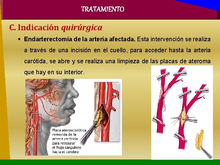 TRATAMIENTO C. Indicación quirúrgica Endarterectomía de la arteria afectada. Esta intervención se realiza a