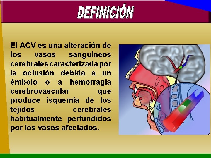 El ACV es una alteración de los vasos sanguíneos cerebrales caracterizada por la oclusión