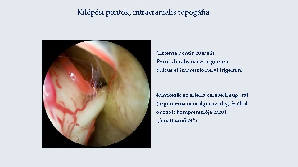 Kilépési pontok, intracranialis topogáfia Cisterna pontis lateralis Porus duralis nervi trigemini Sulcus et impressio