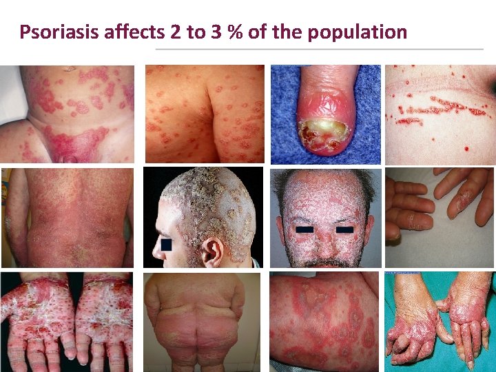 Psoriasis affects 2 to 3 % of the population 