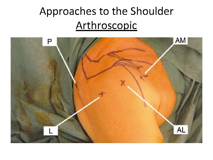 Approaches to the Shoulder Arthroscopic 