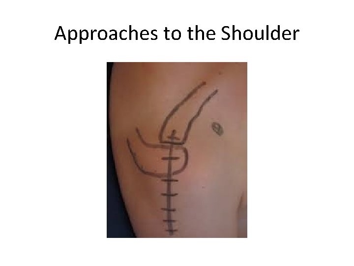 Approaches to the Shoulder 