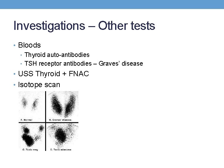 Investigations – Other tests • Bloods • Thyroid auto-antibodies • TSH receptor antibodies – Investigations – Other tests • Bloods • Thyroid auto-antibodies • TSH receptor antibodies –