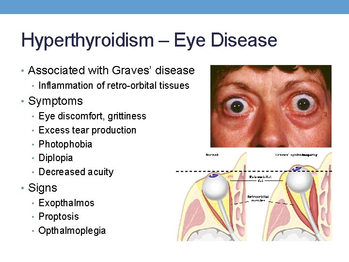 Hyperthyroidism – Eye Disease • Associated with Graves’ disease • Inflammation of retro-orbital tissues Hyperthyroidism – Eye Disease • Associated with Graves’ disease • Inflammation of retro-orbital tissues