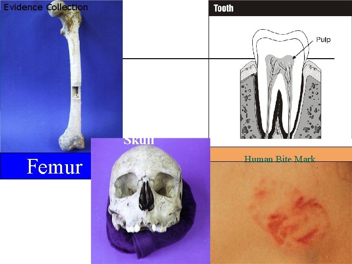 Evidence Collection Skull Femur Human Bite Mark 