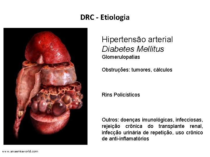 DRC - Etiologia Hipertensão arterial Diabetes Mellitus Glomerulopatias Obstruções: tumores, cálculos Rins Policísticos Outros: