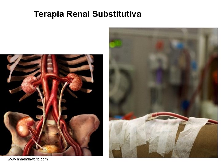 Terapia Renal Substitutiva www. anaemiaworld. com 