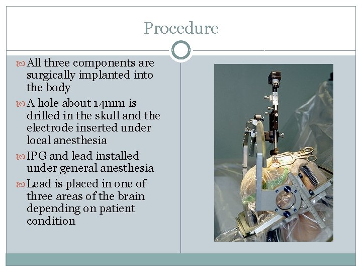 Procedure All three components are surgically implanted into the body A hole about 14