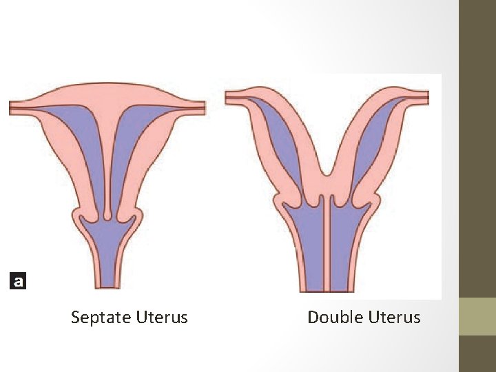 Septate Uterus Double Uterus 