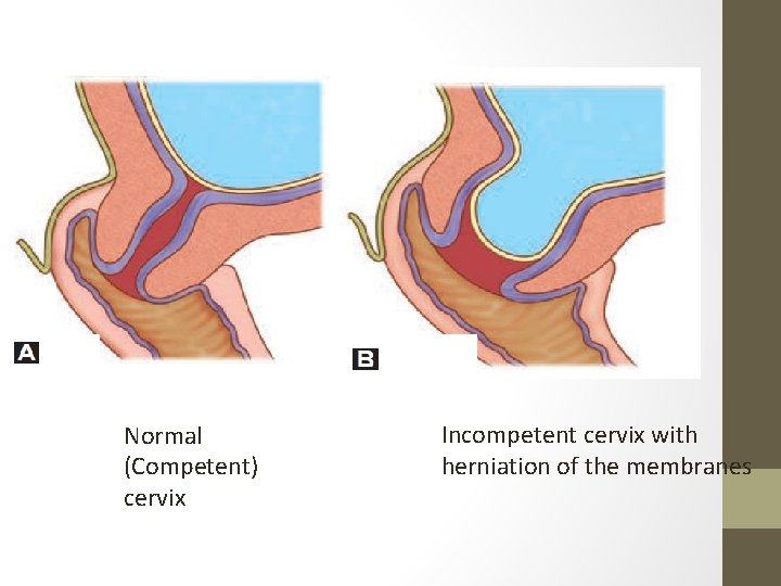 Normal (Competent) cervix Incompetent cervix with herniation of the membranes 