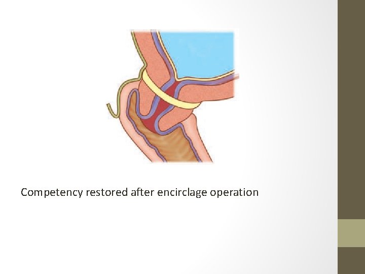 Competency restored after encirclage operation 