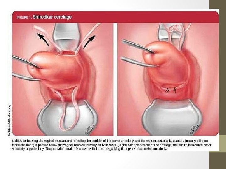 Shirodkar’s cerclage 
