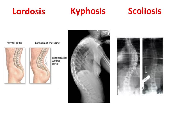 Lordosis Kyphosis Scoliosis 