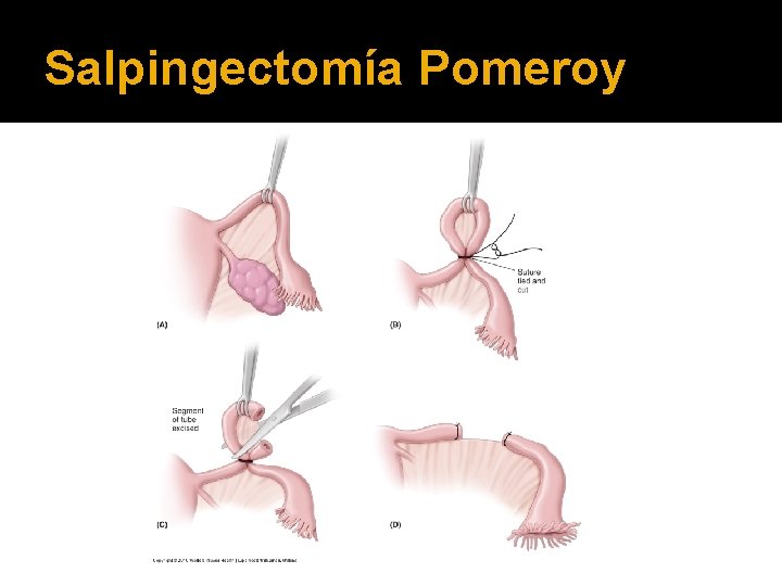 Salpingectomía Pomeroy 