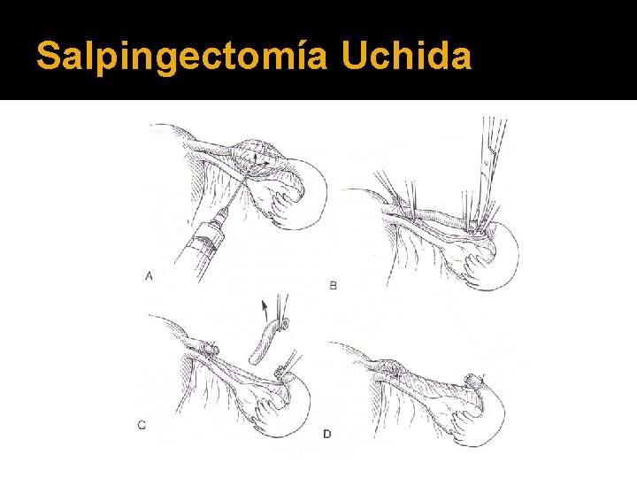 Salpingectomía Uchida 